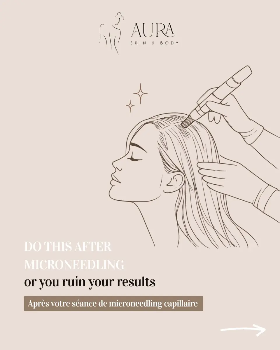 Illustration d'un microneedling du cuir chevelu